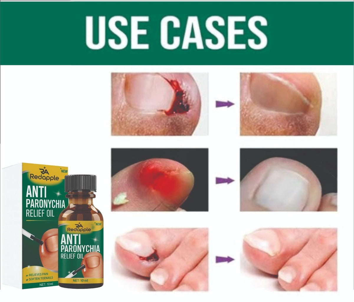 Anti Paronychia Relief Oil 10 ml Pack of 1