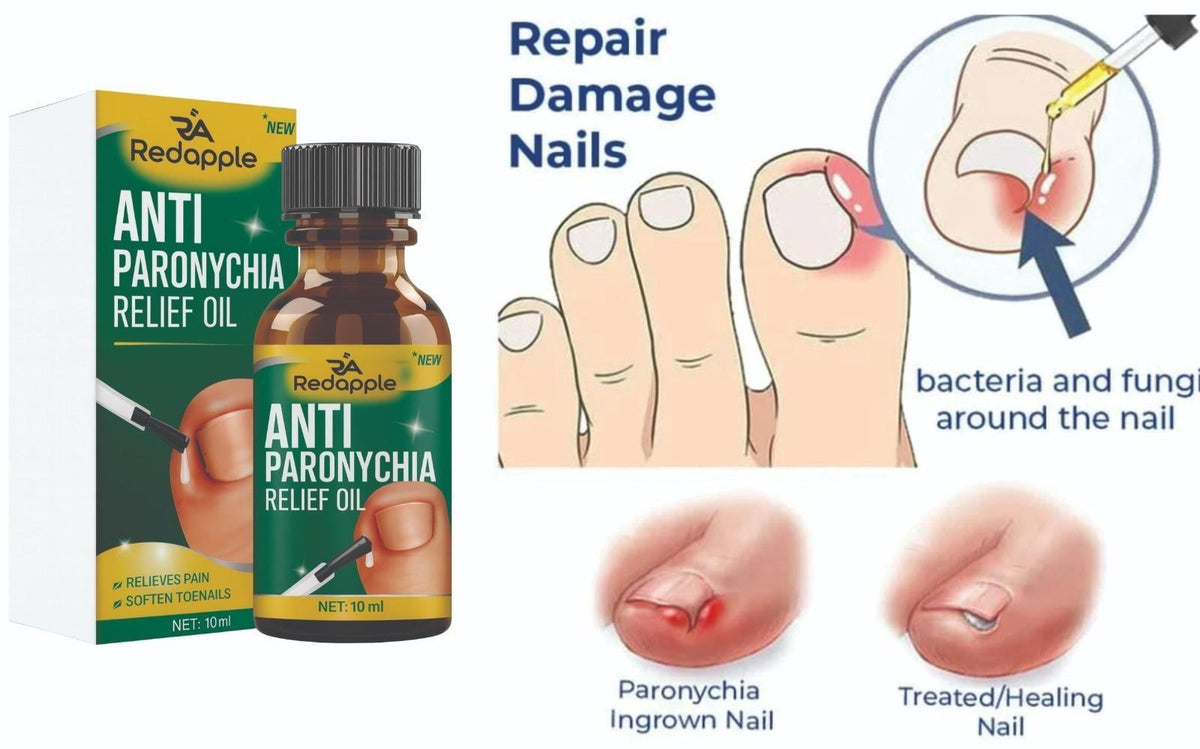 Anti Paronychia Relief Oil 10 ml Pack of 1